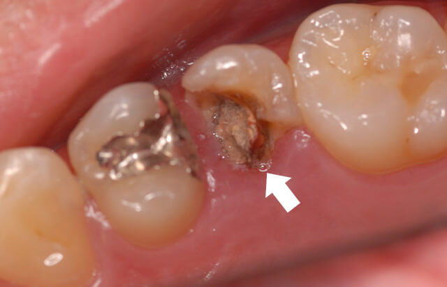 重度な虫歯「歯肉縁下カリエス」に伴う歯周病に注意