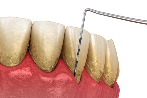 歯周病の進行具合と歯周組織再生療法の関係