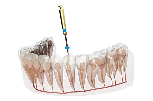 根管治療で行う処置について