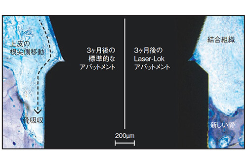 骨吸収を抑制