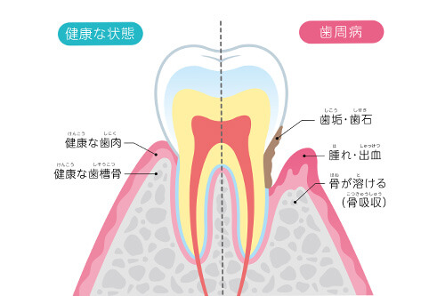 歯周病とは一体？