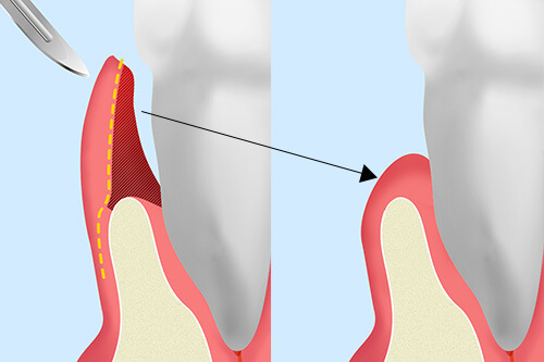 歯肉弁根尖側移動術